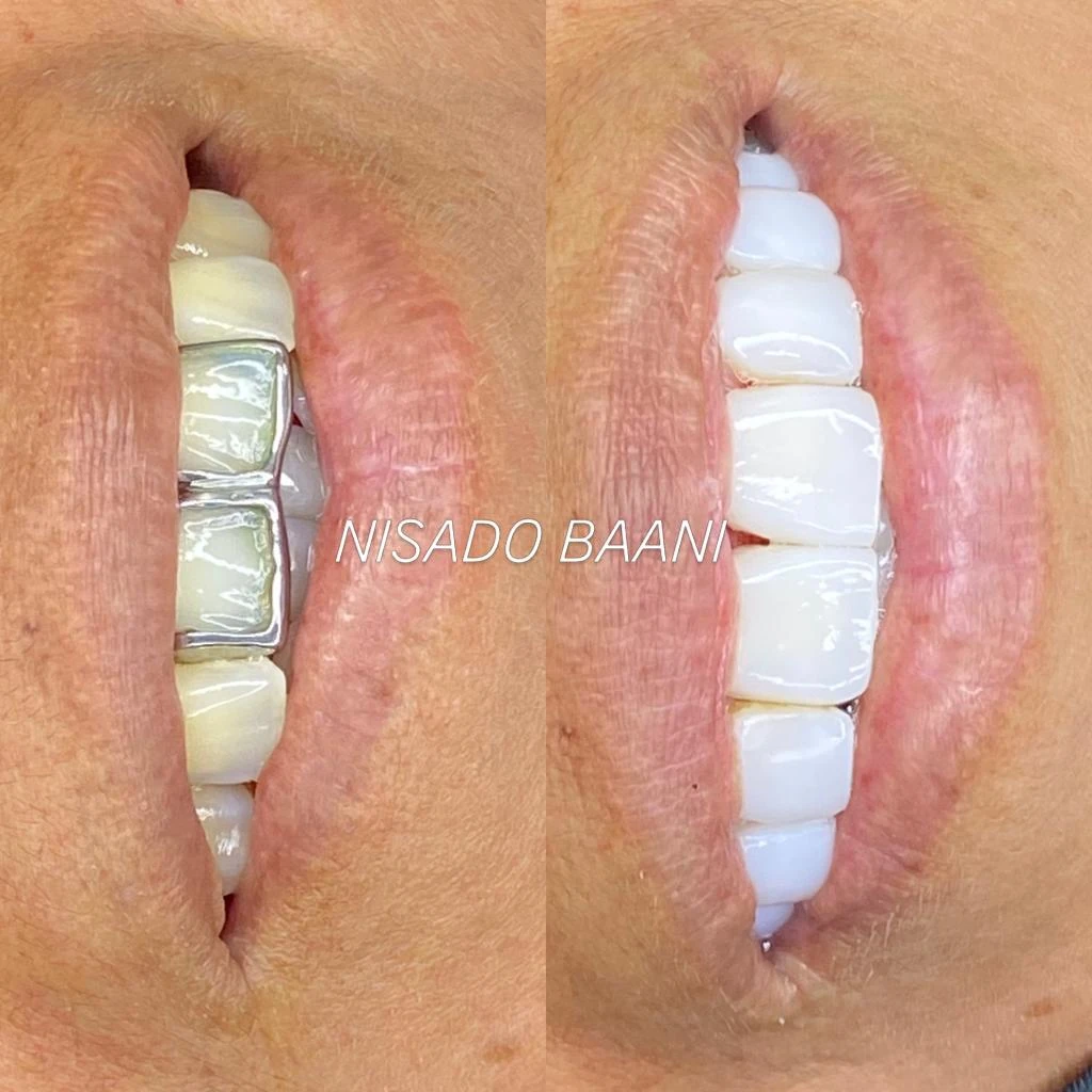 Antes y después de diseño de sonrisa Nisado Baani - Caso 01