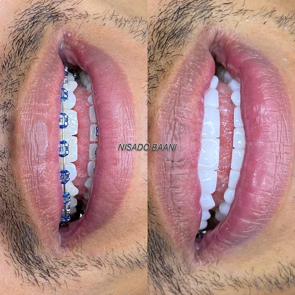 Antes y después de diseño de sonrisa Nisado Baani - Caso 04