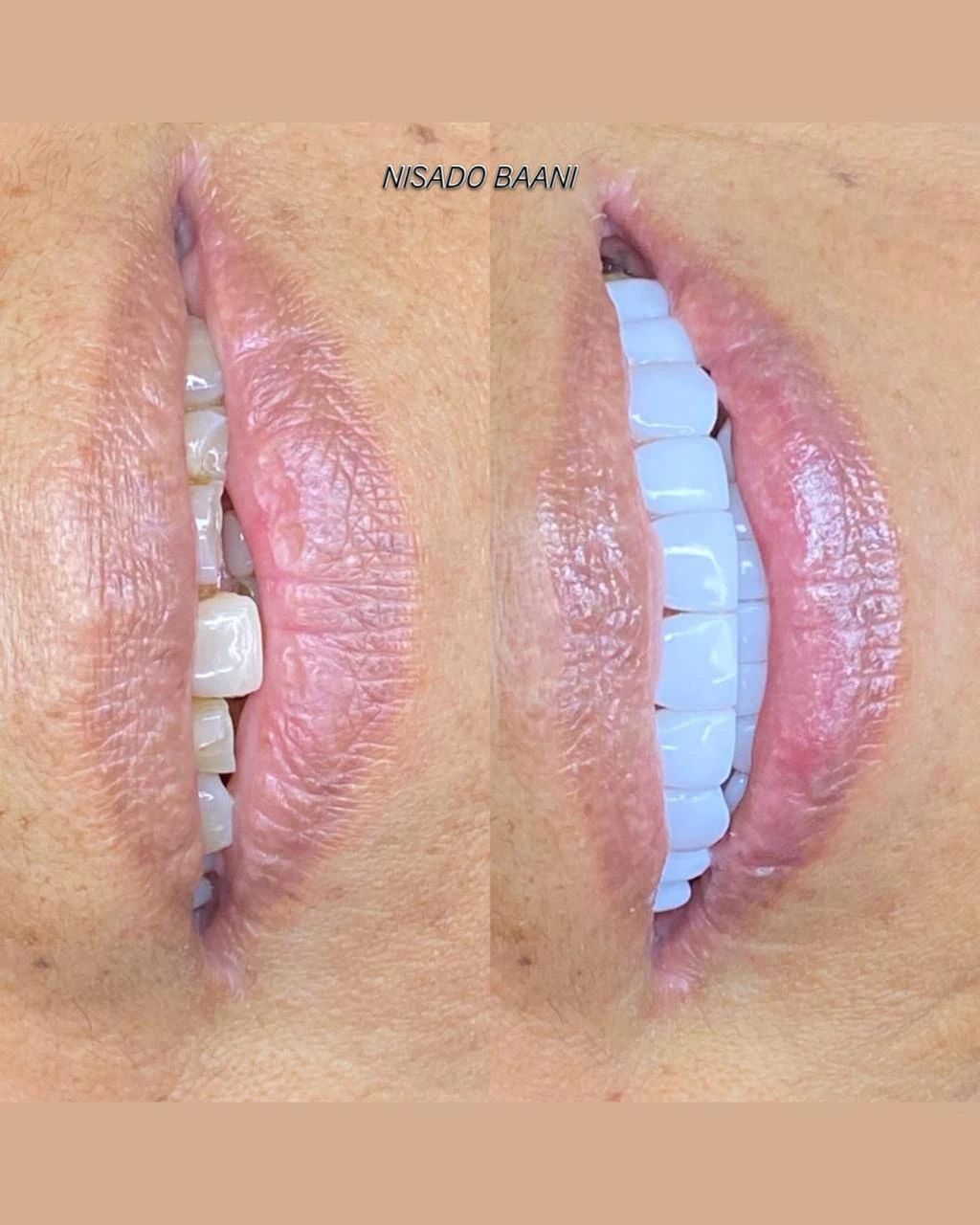 Antes y después de diseño de sonrisa Nisado Baani - Caso 02