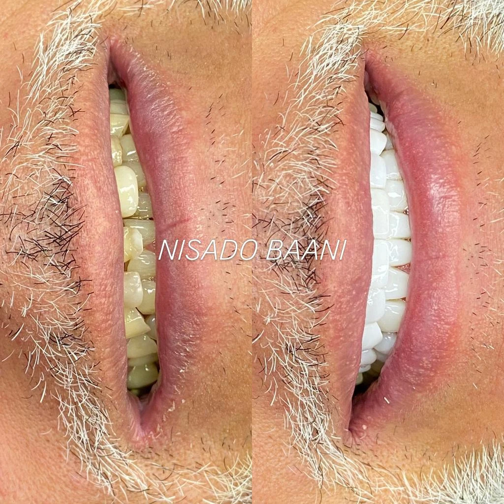 Antes y después de diseño de sonrisa Nisado Baani - Caso 05