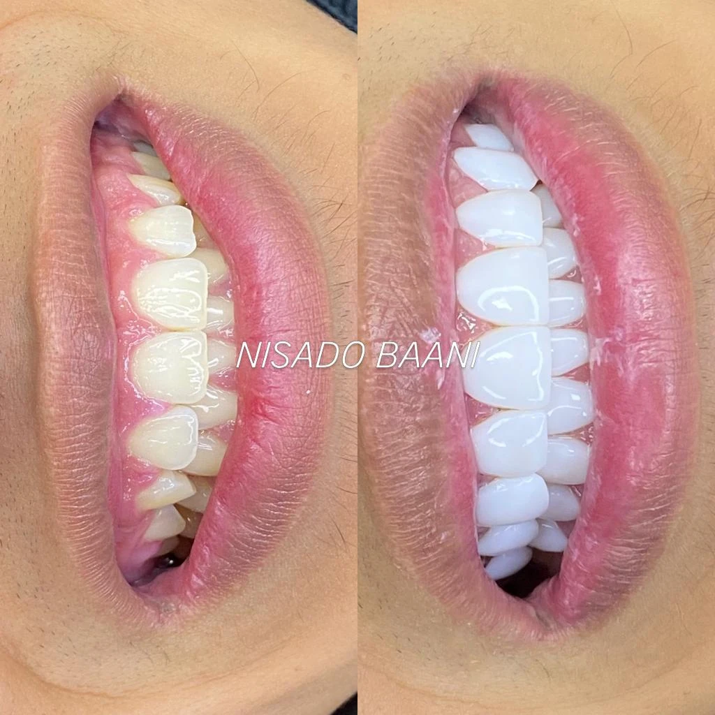 Antes y después de diseño de sonrisa Nisado Baani - Caso 03